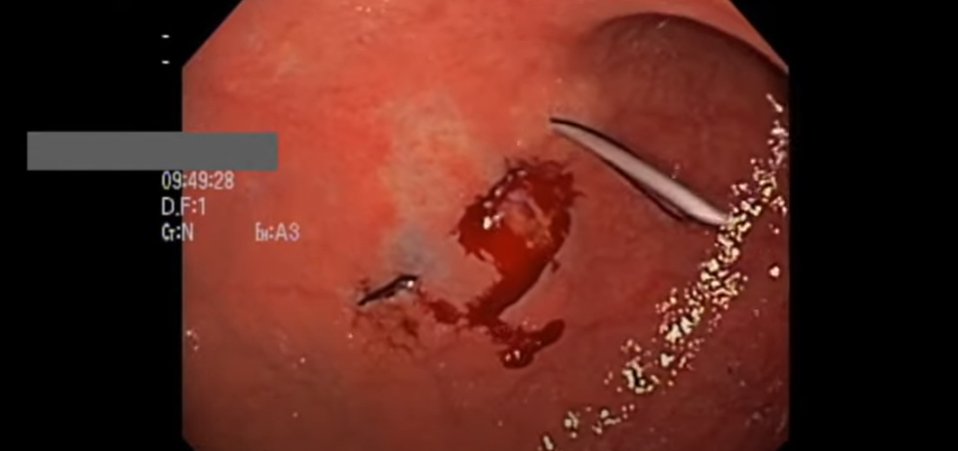 VideoGIE Journal (@videogie) on Twitter photo Sanjhai L. Ramdeen, MD, et al give an overview of the case, background information on gastric volvulus, 3-dimensional models of the types of gastric volvuli, and novel endoscopic and surgical techniques. youtu.be/EvKh33qjN3k
<a href="/DavidDiehlMD/">David Diehl</a>
<a href="/KaraRaphael/">Kara Raphael</a> Sanjhai L. Ramdeen, MD, et al give an overview of the case, background information on gastric volvulus, 3-dimensional models of the types of gastric volvuli, and novel endoscopic and surgical techniques. youtu.be/EvKh33qjN3k
<a href="/DavidDiehlMD/">David Diehl</a>
<a href="/KaraRaphael/">Kara Raphael</a>