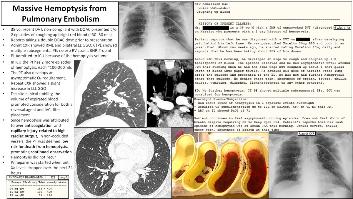 Hemoptysis
DO NOT
1) Risk Stratify via expirated blood  estimation
2) Attemp to localize active bleeding via bronchoscopy
3)  Intubate preemptively
4) Stop AC in PE
#Pulmonary #Criticalcare #Emergencymedicine #InterventionalRadiology #anesthesiology #Meded #medtwitter #medicine