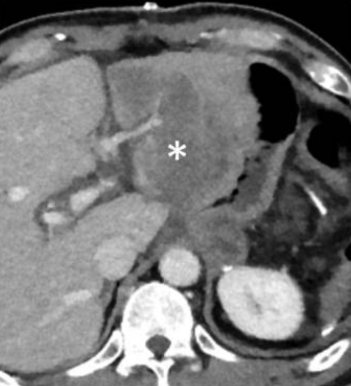Status post partial gastrectomy. What is the diagnosis and its mechanism?

Courtesy of: ncbi.nlm.nih.gov/pmc/articles/P…

#radiology #surgery #medicine #medtwitter #radtwitter #surgerytwitter #meded #raded #gastrectomy #bariatric #cancer #gastrointestinal #GI #liver