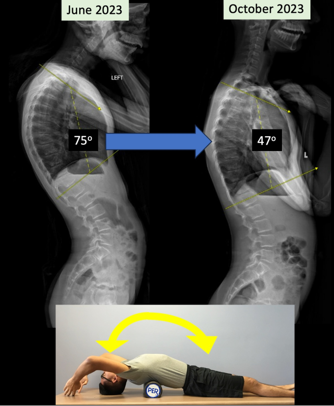 Surgery was initially recommended for a 12yo girl with 75deg of #Kyphosis. During a second opinion, I offered hyperextension #stretching for just 60 seconds each day. Months later her spine was straighter & surgery was avoided. #conservativetreatment