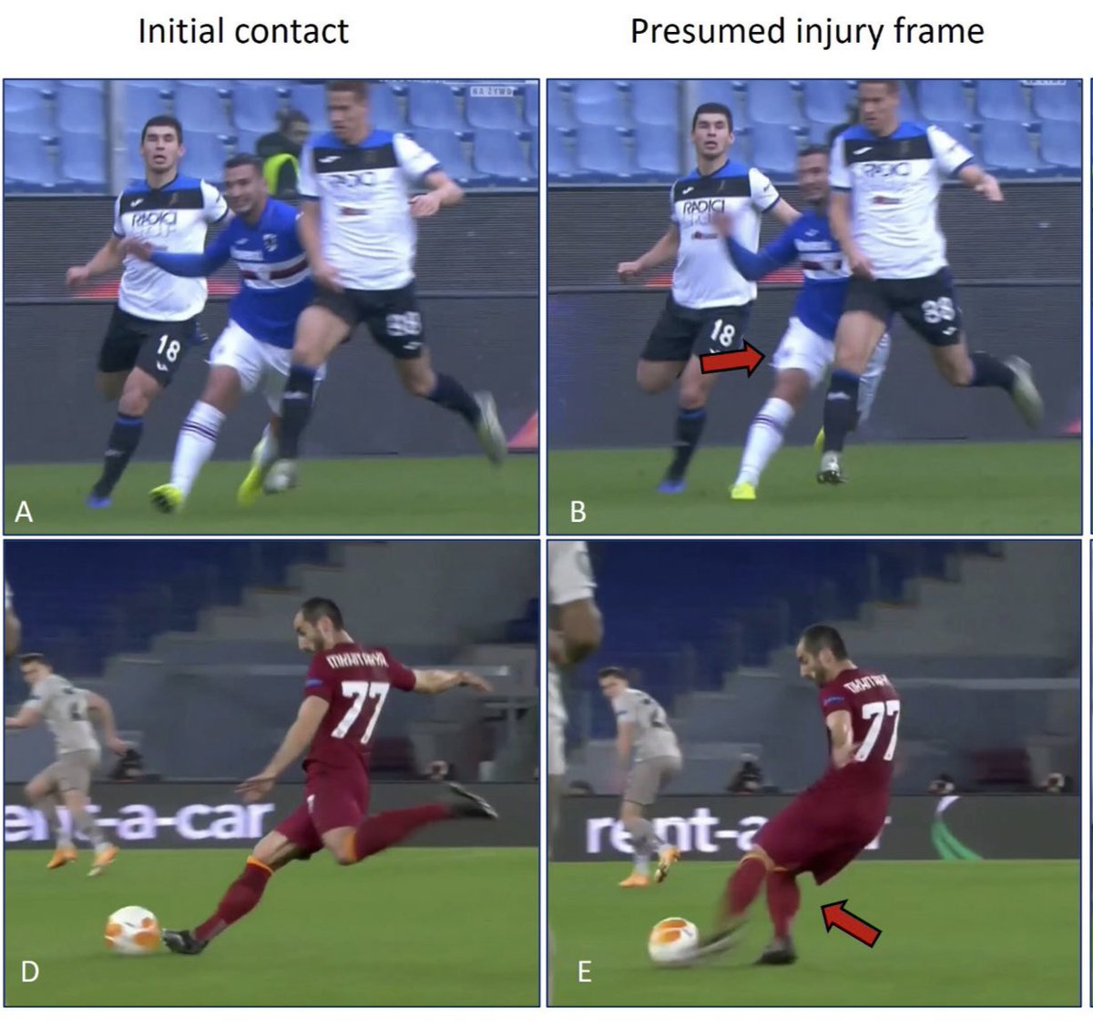 FDellaVilla's tweet photo. Results of our latest video analysis study on Football Muscle Injuries just published on @BJSM_BMJ 

- 103 severe muscle injuries
- 83% non contact
- 4 main patterns 
- Role of CKC Stretching 
- 1st 45’

https://t.co/DzXWiYOU8Z
@footballmed @IsokineticMed @m_buckthorpe https://t.co/Db7HyCUv7W