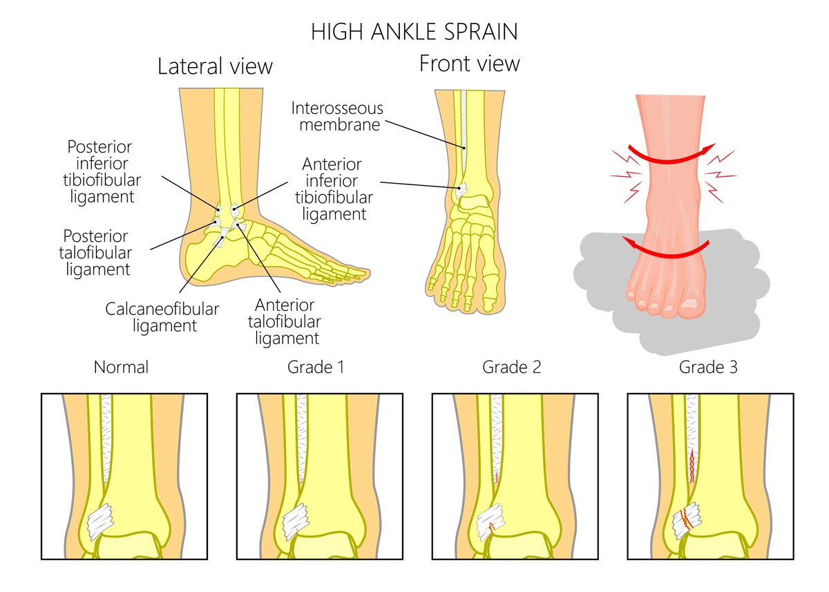 🦶High Ankle Sprains (ankle syndesmosis injury) can take up to 2-4 times longer to recover compared to lateral ankle sprains.🦶

The diagnostic accuracy of our clinical tests are of low sensitivity and specificity. 📊

It's recommended that a cluster of tests are performed.

A