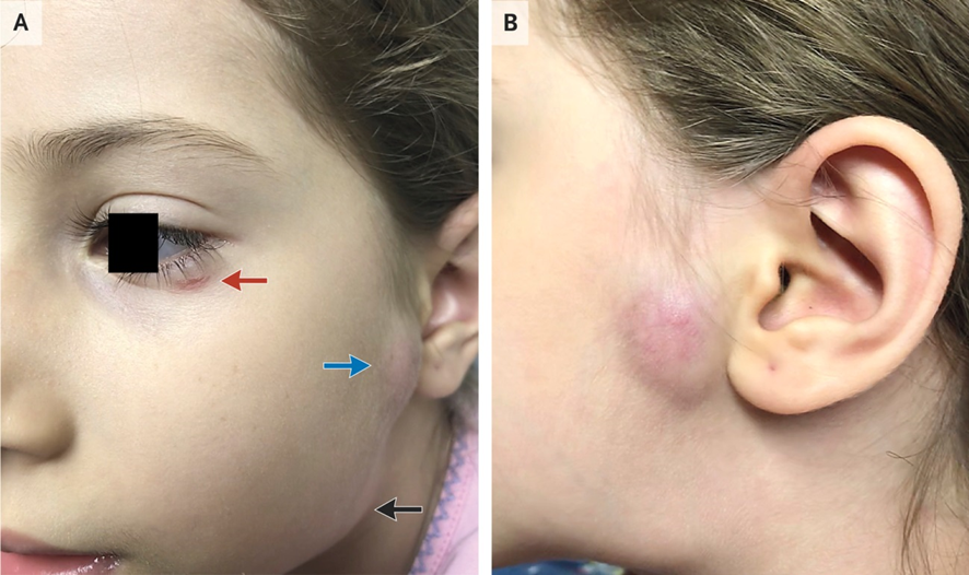 5 años♀️, jugaba con frecuencia con su #gato: 
✔️Una excoriación (A, flecha roja), 
✔️una masa preauricular fluctuante y sensible (A, flecha azul; y B) 
✔️y una adenopatía submandibular (A, flecha negra).
1/3

DOI: 10.1056/NEJMicm1804942
#Pediatría #medicina