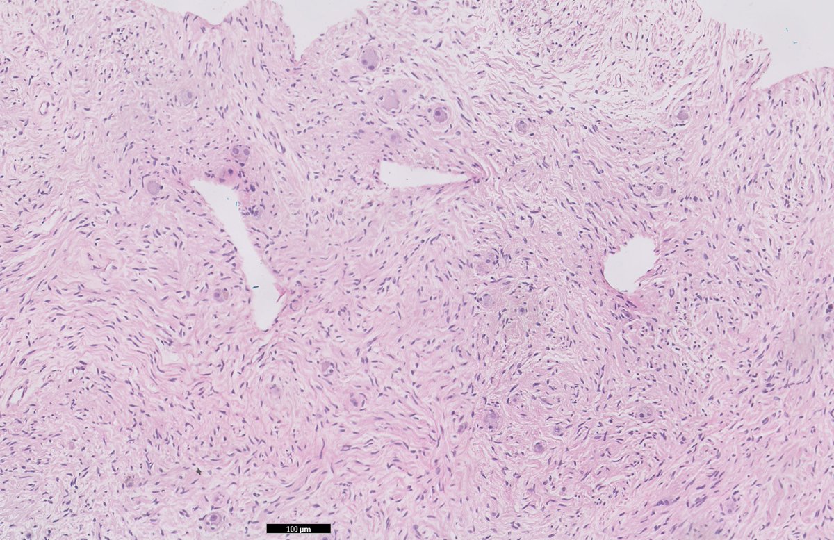 RyCPatologia's tweet photo. ➡️ Lesión retroperitoneal en paciente de 60 años.
🔬 IHQ: S100, NF, enolasa.
☑️ Ganglioneuroma.
#rycpath #BSTpath https://t.co/7We1QC3Ue1
