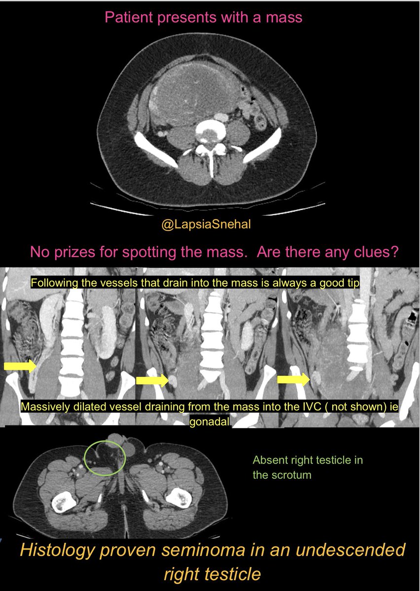 This case provided much debate between team GI and team GU in our hospital!! Vessels never lie #FOAMrad #FOAMed #meded #radres #futureradres #medstudenttwitter #gitwitter #anatomy #frcr #surgery #radiology #radtwitter #medtwitter #urology #sarcoma