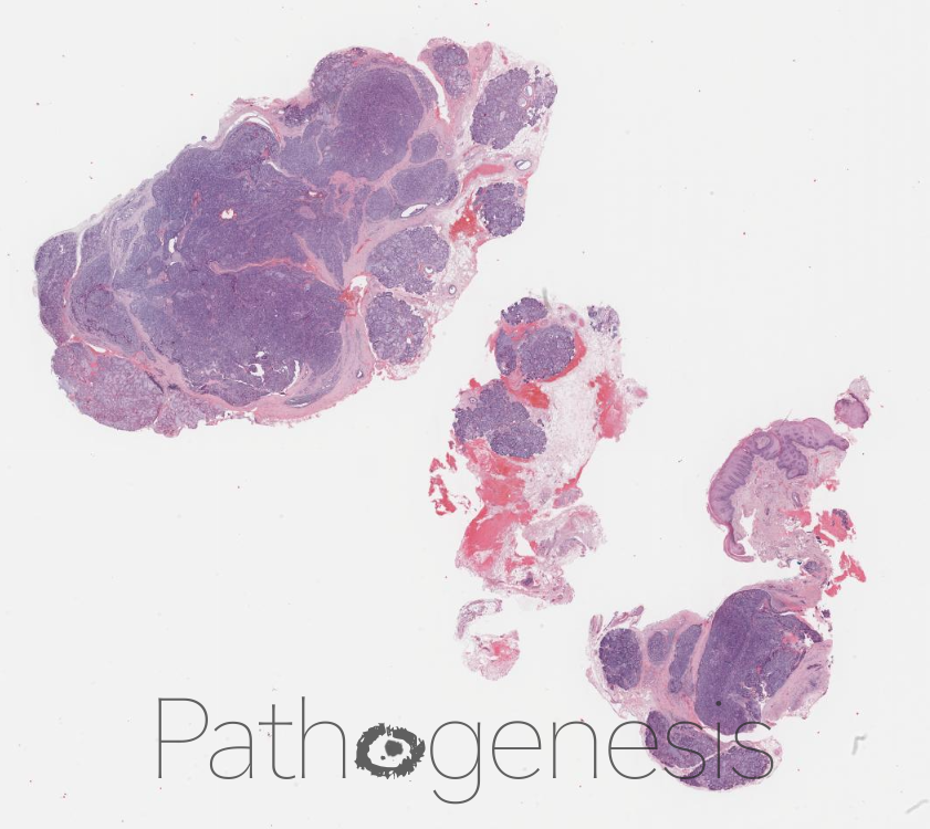 Ali Khurram (@sakhurram) on Twitter photo <a href="/theBSOMP/">BSOMP</a> Case of the Month for Nov/Dec 23 is now live.
Visit bsomp.org.uk/cotm for details.
Case credit- <a href="/HaizalMh/">Haizal Hussaini</a>
WSI credit-<a href="/pathogenesisDP/">Pathogenesis</a>
#bsomp #COTM #oralandmaxillofacialpathology #ENTpathology #headandneckpathology <a href="/theBSOMP/">BSOMP</a> Case of the Month for Nov/Dec 23 is now live.
Visit bsomp.org.uk/cotm for details.
Case credit- <a href="/HaizalMh/">Haizal Hussaini</a>
WSI credit-<a href="/pathogenesisDP/">Pathogenesis</a>
#bsomp #COTM #oralandmaxillofacialpathology #ENTpathology #headandneckpathology