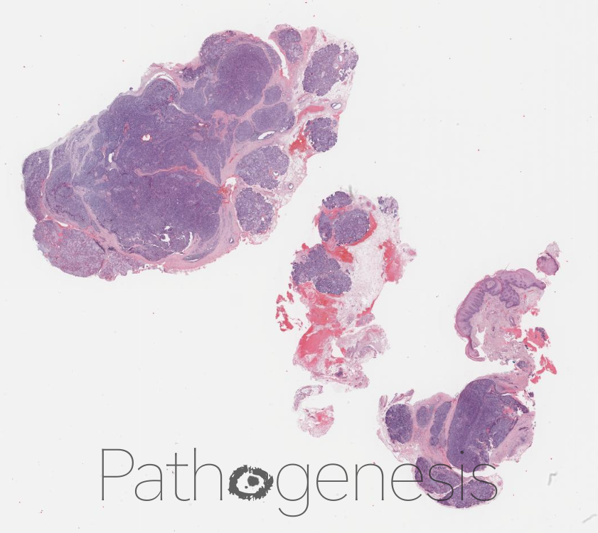 @theBSOMP Case of the Month for Nov/Dec 23 is now live. Visit bsomp.org.uk/cotm for details. Case credit- @HaizalMh WSI credit-@pathogenesisDP #bsomp #COTM #oralandmaxillofacialpathology #ENTpathology #headandneckpathology