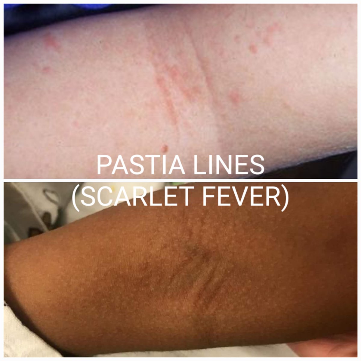 Pastia lines, or Pastia's sign, are caused by petechiae in creases of the skin during a scarlet fever infection. These lines are almost inevitably described as red or pink, but as seen in the above photo, may not appear at all red or pink on skin of color. #medt