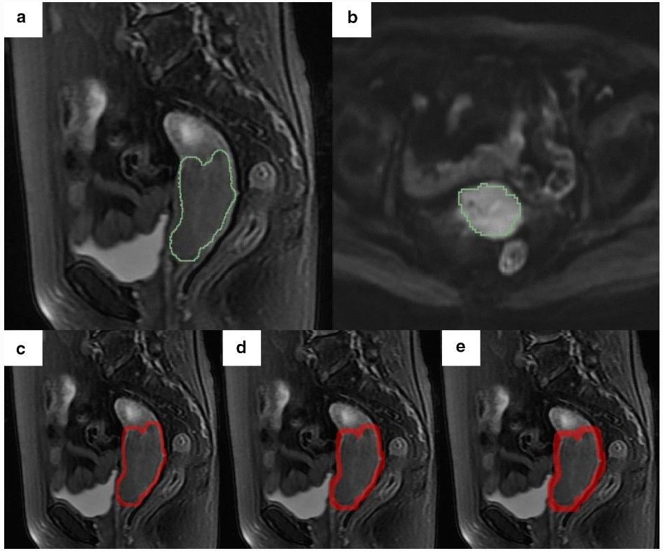 #Radiomics features extracted from both intra- and peritumoral regions in T2WI and DWI are promising preoperatively predict lymph node metastasis in early-stage #CervicalCancer patients. (Zhenhua Zhang et al.) #InsightsIntoImaging #MRI 🔗 buff.ly/46LWgrZ