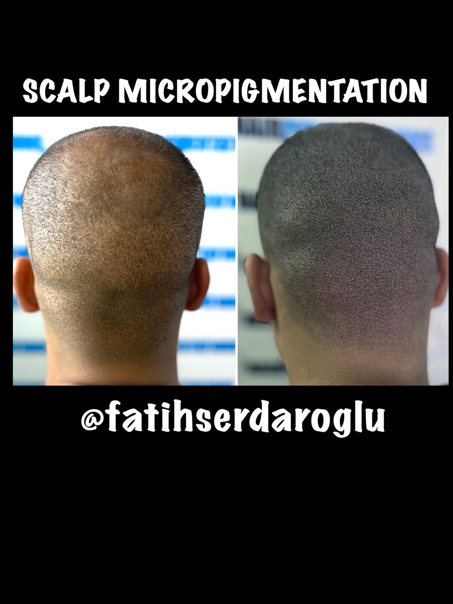 fatihserdaroglu's tweet image. #scalpmicropigmentationtraining
#scalpmicropigmentation
#saçpigmentasyonu
#haarpigmentierung
#hairpigmentation
#saçdövmesi
#saçsimülasyonu
#saçgölgelendirmesi
#tricopigmentation
#hairtattoo