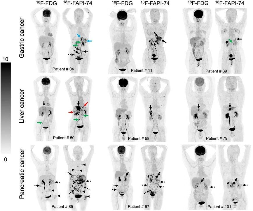 AuntMinnie's tweet photo. FAPI-PET bests FDG-PET in detecting gastrointestinal cancer #radiology https://t.co/sTph5l744Y https://t.co/SEqVj9Mp2h