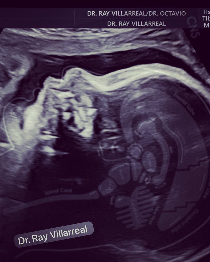 DrRayVillarreal's tweet photo. @OGdukeneurosurg https://t.co/AhOVab23Wb
