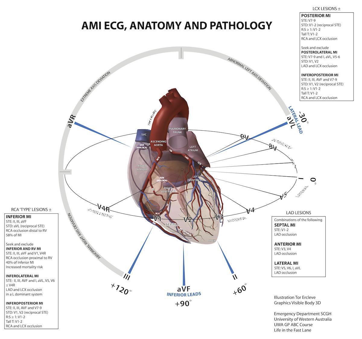 AMI ECG, Anatomy and Pathology <a href="/LITFLblog/">LITFL</a> #MedEd
