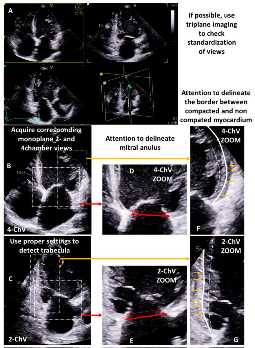 ZHeart11768530's tweet photo. Valid and Reproducible Quantitative Assessment of Cardiac Volumes by Echocardiography in Patients with #VHDs—Possible or Wishful Thinking? @JCM_MDPI
https://t.co/TVSUVqsr9F
#echofirst #cardiology #CardioEd #CardioTwitter #2023review #OpenAccess https://t.co/gLoaaygq3p