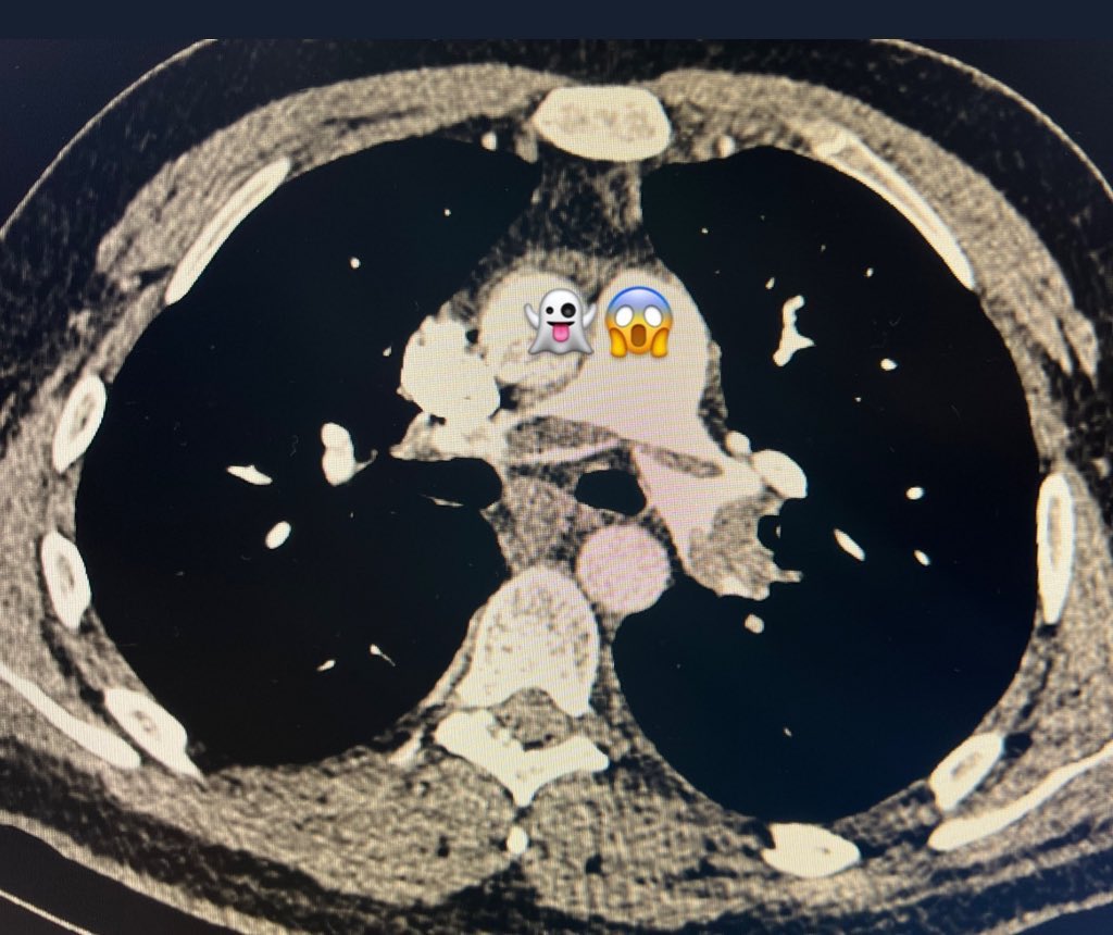 KhanFaridMD's tweet image. It’s Halloween 👻 😧 
#CardioX #PulmCrit