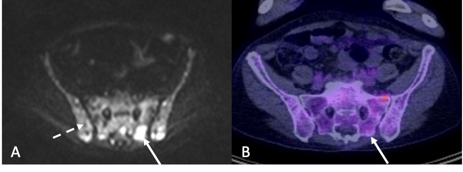 Another leap for quality-controlled WB-MRI for #myeloma . Huge opportunity for better imaging data in trials and their analysis. Amazing collaboration @CTRUmyeloma , thanks @JanssenEMEA @bmsnews for support. Interested in myeloma WB-MRI? see poll tweetorial below 👇 1/10