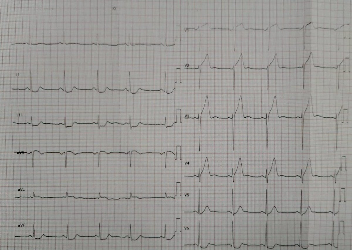 NeuroQuinn's tweet image. Normal axis 
Sinus rhythm @ 60 bpm 
Resolving  anterior STEMI with inferior reciprocal changes ( OMI ) 
Proximal LAD occlusion.

#EmergencyMedicine  #Cardiology #ECGAnalysis