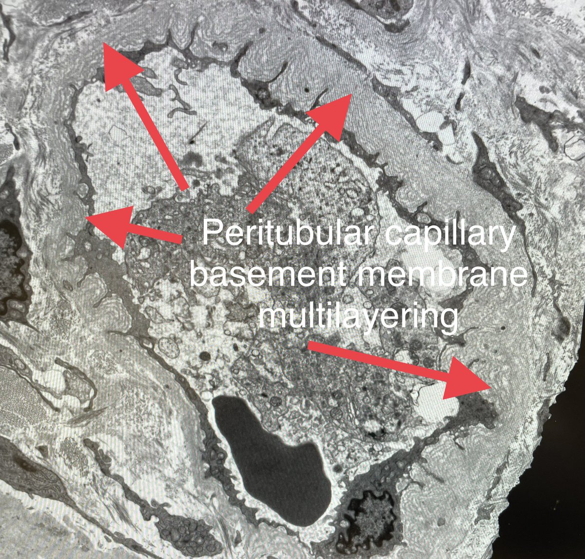 Classic EM findings of chronic antibody mediated rejection. New basement membrane (arrows)

1. Glomerulus showing double contour along capillary walls

2. Peritubular capillary showing multilayering of basement membranes

45-yr old, kidney transplant 5 yr, proteinuria 2 gms, Cr 2