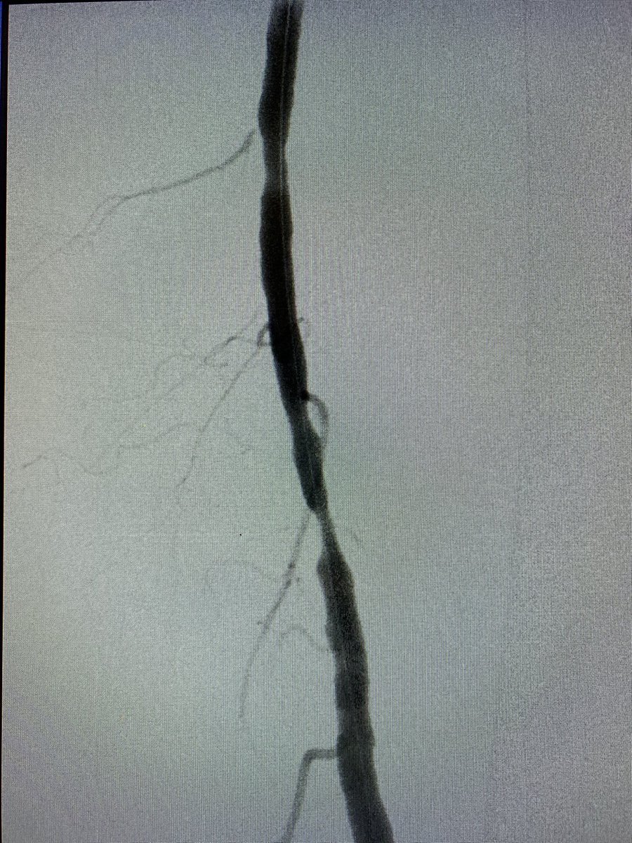 Houston Combined IR Residency (@hcirad) on Twitter photo Before and after SFA atherectomy and angioplasty for CLI. #stopthechop <a href="/SIRspecialists/">Society of Interventional Radiology</a> <a href="/SIRRFS/">SIR RFS</a> <a href="/MDAndersonNews/">MD Anderson Cancer Center</a> <a href="/Interventional2/">The II</a> Before and after SFA atherectomy and angioplasty for CLI. #stopthechop <a href="/SIRspecialists/">Society of Interventional Radiology</a> <a href="/SIRRFS/">SIR RFS</a> <a href="/MDAndersonNews/">MD Anderson Cancer Center</a> <a href="/Interventional2/">The II</a>
