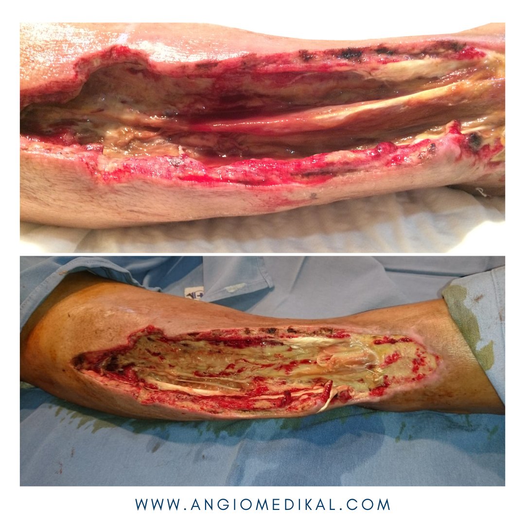 angioycvascgdl's tweet photo. ✅Cicatrización de herida en pierna con uso de terapia VAC ⭐️⭐️⭐️⭐️⭐️⠀
💙Gracias por la confianza!⠀
Acude con tu Angiólogo Certificado 💜
🌐 https://t.co/f5FNnNioL9
#angiotips #VAC #terapiaVAC #herida #heridacronica #angiologo #guadalajara #gdl #zapopan #VACtherapy https://t.co/9ieQEuUNZf