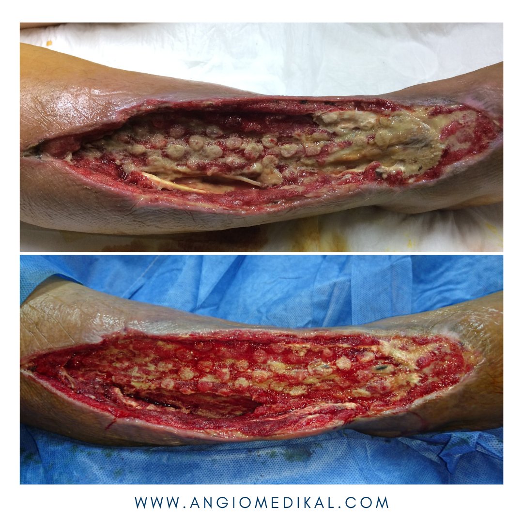 angioycvascgdl's tweet photo. ✅Cicatrización de herida en pierna con uso de terapia VAC ⭐️⭐️⭐️⭐️⭐️⠀
💙Gracias por la confianza!⠀
Acude con tu Angiólogo Certificado 💜
🌐 https://t.co/f5FNnNioL9
#angiotips #VAC #terapiaVAC #herida #heridacronica #angiologo #guadalajara #gdl #zapopan #VACtherapy https://t.co/9ieQEuUNZf