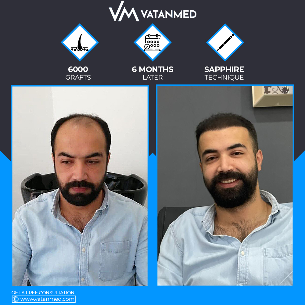 Vatanmed Hairtransplant Vatanmedsacekim Twitter Vatanmed Hairtransplant Vatanmedsacekim Twitter