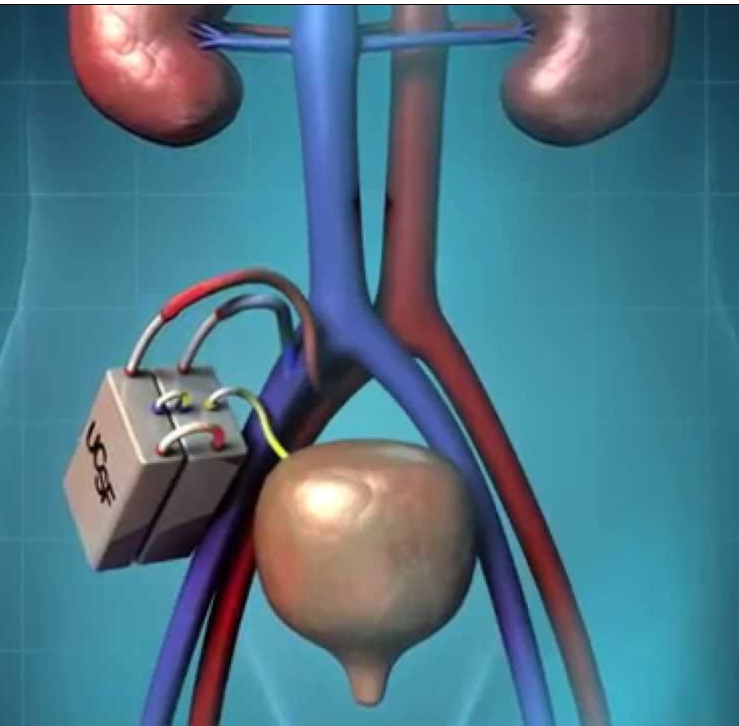 #فضفضة_طبيب سأتحدث عن ما يسمى ب #الكلية_الصناعية الذي كثر الحديث عنها مؤخرا، و هل هي علاج متوفر الان...