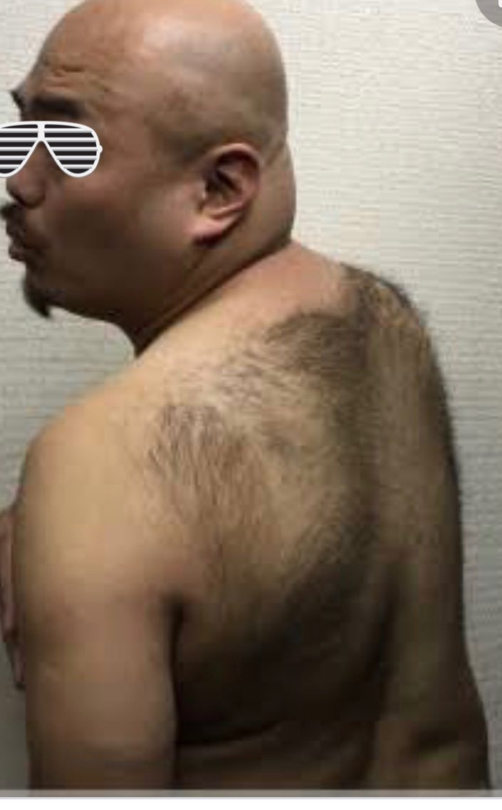 背中に黒い毛生えてきて 範囲も広くなってきた。 13歳10ヶ月. 以前は