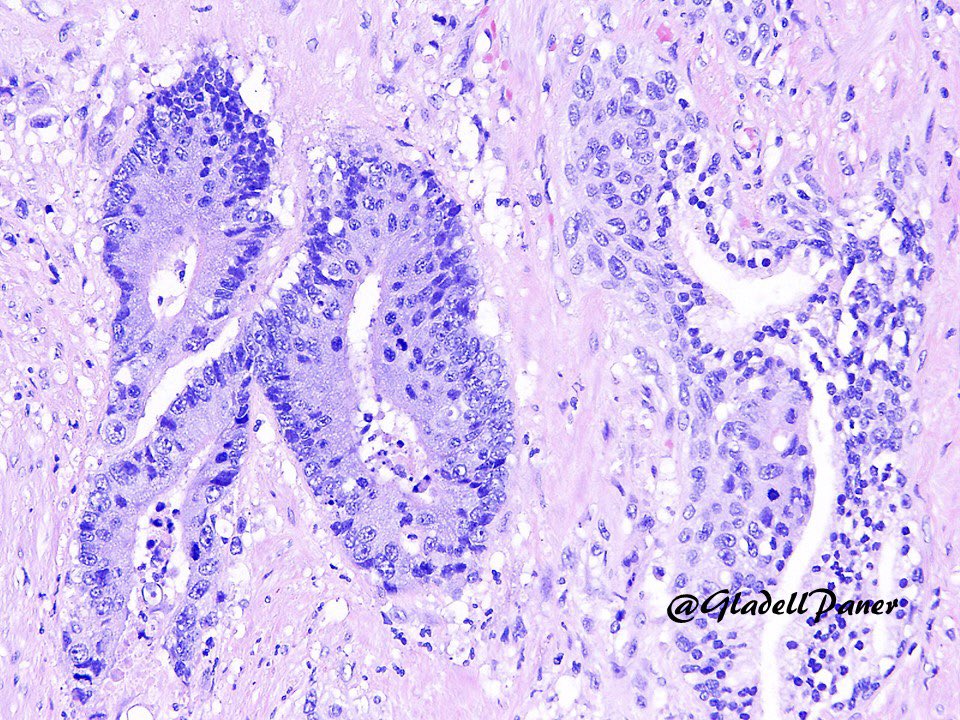 Face to face. Colorectal adenocarcinoma glands next to a benign prostatic gland. #GUPath