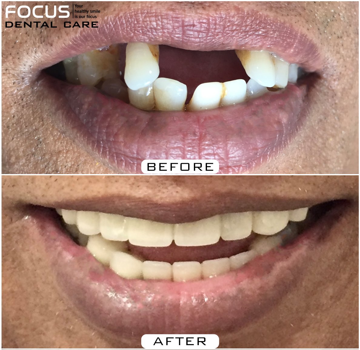 FDCDentistry's tweet photo. πFull Mouth Rehabilitation with Dental Implants
or visit us at: https://t.co/ESLFpwuySb
#DentalImplants #fullmouthrehab #FullmouthRehabilitation #FullMouthImplants #Implants #DentalVeneers #DentalCrowns #Smilemakeover #Smiledesign #Smiledesigner #Allon6 #Allon6implants #Allon4 https://t.co/efDKPUsJYq