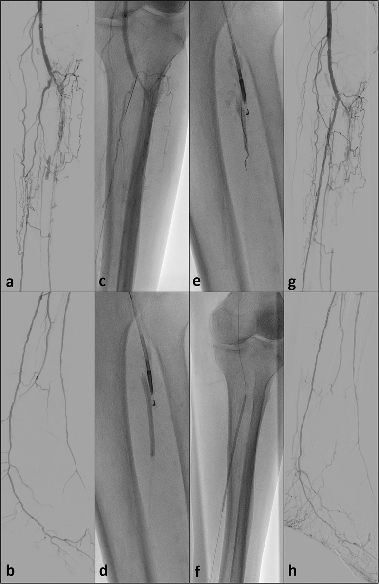 cvirendo's tweet photo. Suboptimal chronic occlusions? Go subintimal!
Maybe this #cvirendo original article on targeted tibio-peroneal re-entry during #subintimal #revascularization using the Outback® catheter and targeted tibio-peroneal re-entry can help!
https://t.co/fSGeECEOQS https://t.co/YjODgXnrZo
