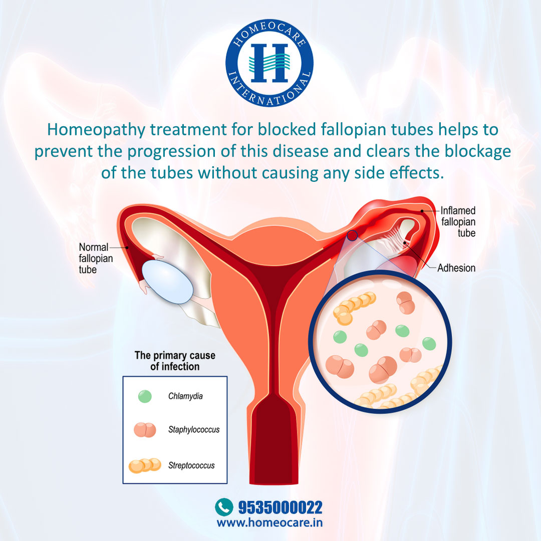 homeocareint's tweet photo. Homeopathy treatment for blocked fallopian tubes helps to prevent the progression of this disease and clears the blockage of the tubes without causing any side effects. For more information, please visit https://t.co/y5QuzXsBDr
#homeocareInternational #blockedfallopiantubes https://t.co/dmNxsmDeJi