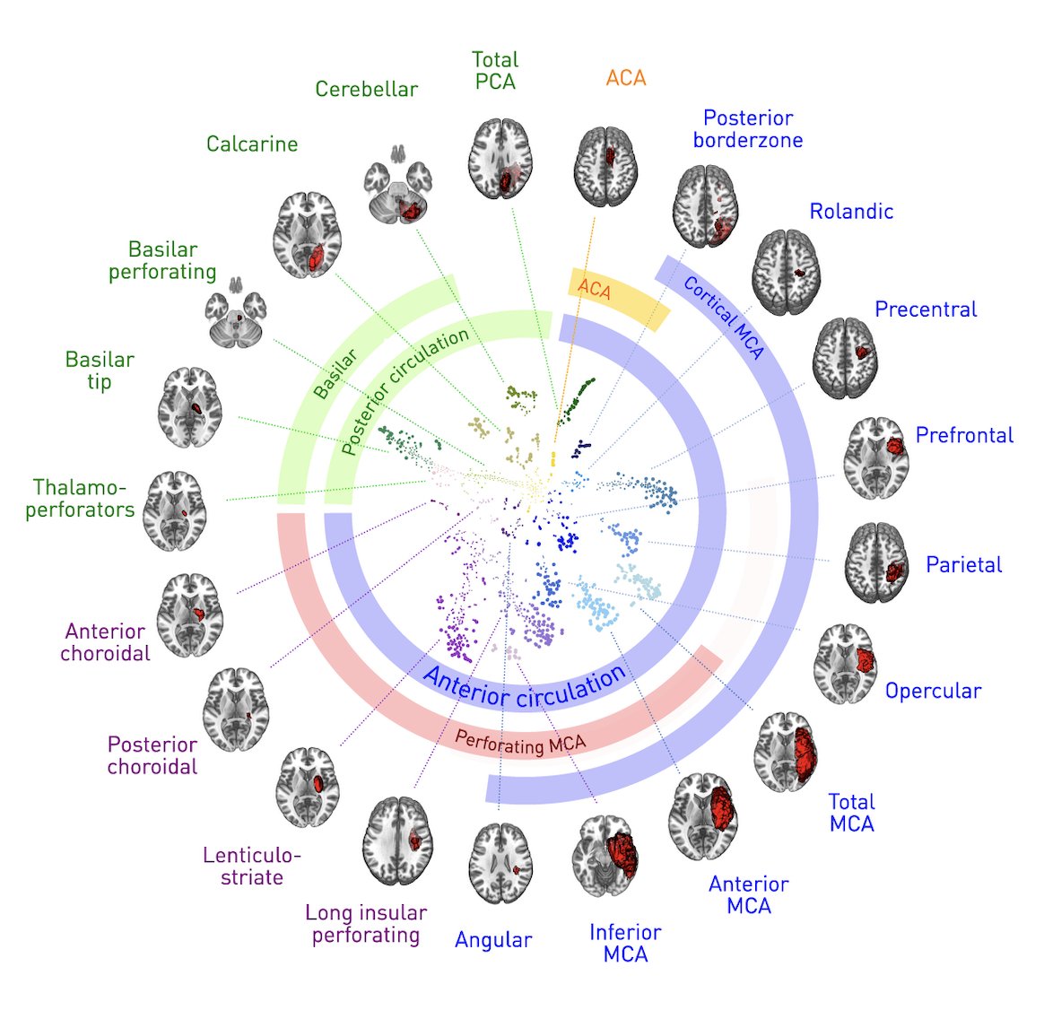 annabonkhoff's tweet photo. How exciting to see my very first #BigData #Stroke project now out in @CORTEXjournal!

"Reclassifying stroke lesion anatomy" 

Wonderful times @UCL_ICN &amp; working w/ Parashkev Nachev and the #high-#dimensional #neurology lab!

👉 https://t.co/KtVtIhYSOW https://t.co/mkOYy56QaL