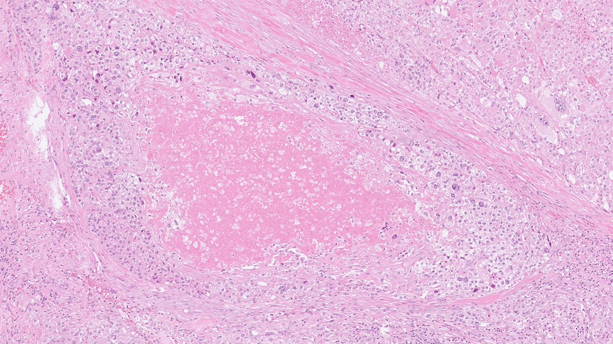 DrJuhlin's tweet photo. 70-y-o male, 70 mm adrenal mass. Tumor necrosis, pleomorphism and capsular invasion is seen. https://t.co/Dlg6JGQknJ