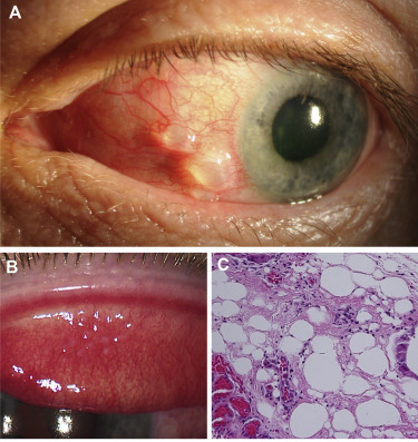 Case of giant papillary conjunctivitis 5 months after #retinaldetachment repair with silicone oil that was complicated by massive postoperative subconjunctival oil leak. <a href="/AmyLinCornea/">Amy Lin</a> ow.ly/kV6I50Getzf