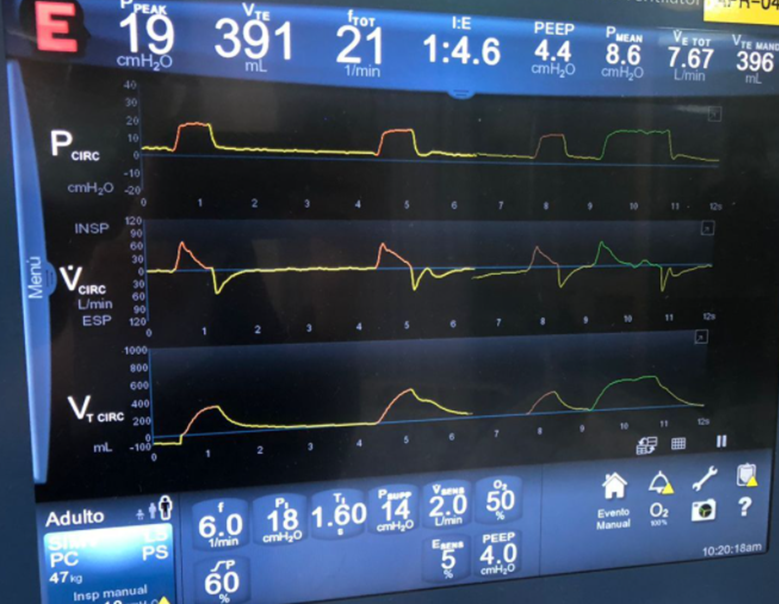 I got the waveforms for tomorrow's Mexico VentRounds at 3PM EST. I love screens that keep the past shaded, full of clues. Here is the Link: cmrccf.webex.com/cmrccf/j.php?M…
<a href="/Karina_RS12/">Karina Rosas Sánchez</a> <a href="/curso_vm/">Angelo Roncalli</a>  <a href="/JHUPCCMFellows/">Johns Hopkins University PCCM Fellowship</a> <a href="/CCF_PCCM/">CCF Pulmonary and Critical Care Fellows</a> <a href="/UChicagoPCCM/">PCCM UChicago</a> <a href="/UNMC_PCCM/">UNMC PCCM</a> <a href="/SMHCoEMV/">Centre of Excellence in Mechanical Ventilation</a> <a href="/snamendys/">Silvio A. Ñamendys-Silva</a> <a href="/msiuba/">Matt Siuba</a> #FOAMed