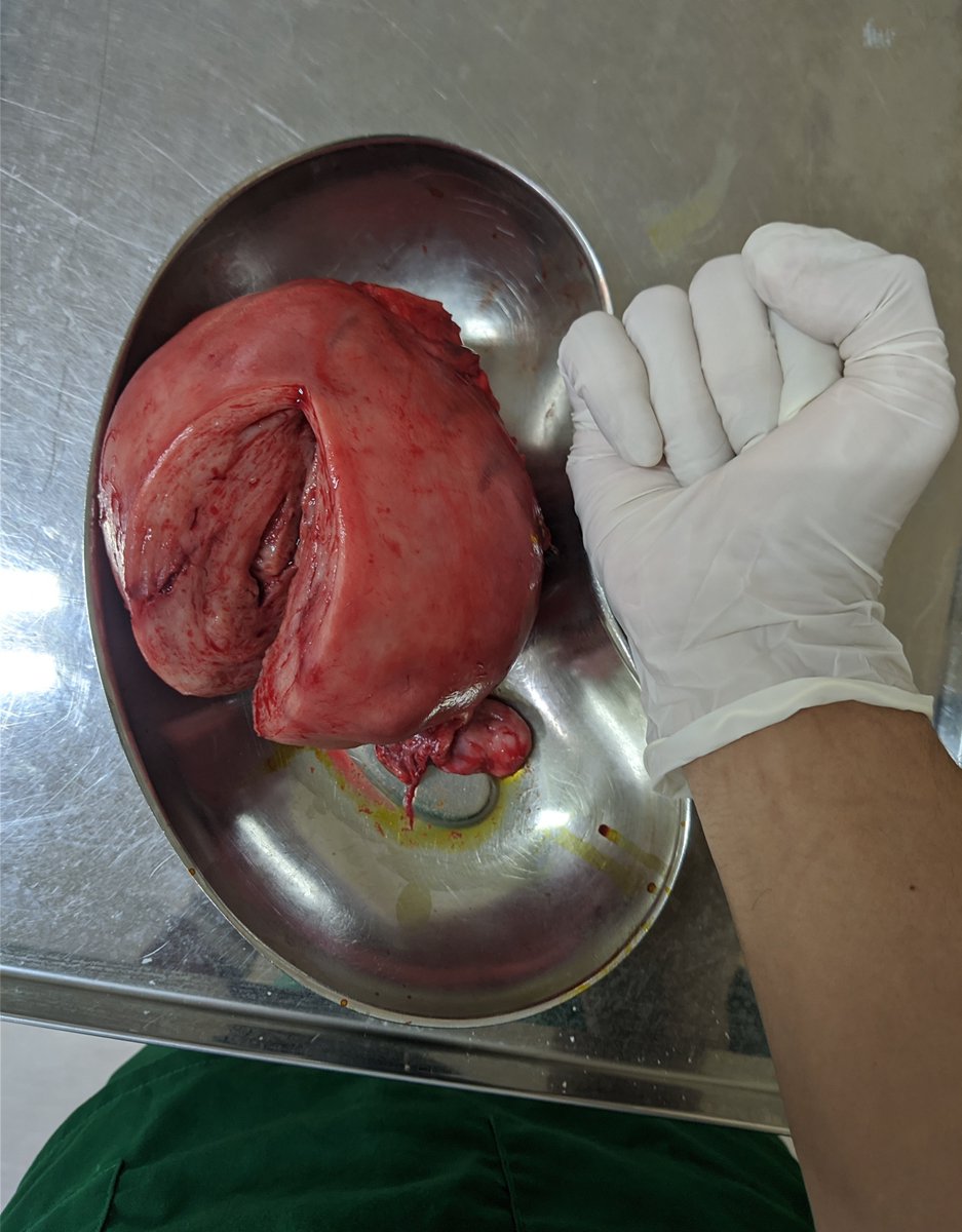 ROYU_ID's tweet photo. Histerektomi : suatu istilah medis yang merupakan prosedur pengangkatan uterus/rahim pada kasus tertentu. contoh kasus pada gambar yaitu mioma uteri = pertumbuhan massa/daging pada uterus yg disebabkan multifaktor salah satunya gangguan hormonal (estrogen) https://t.co/BHyO8IhzcQ