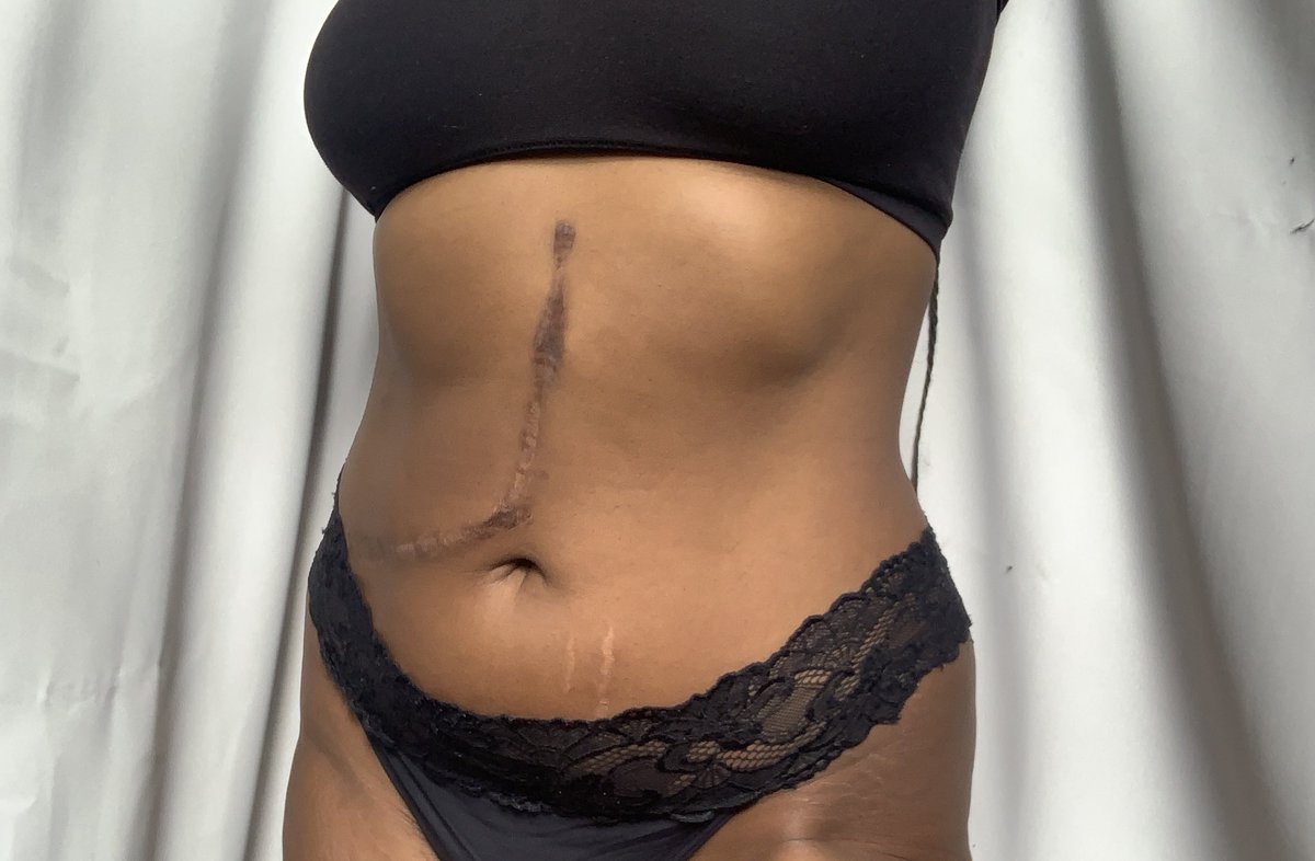 emmatabithaa's tweet photo. I want to be the representation I don’t have. 
I am happy with my body. My body that houses my chronic illness but keeps me pain free. 
I love every scar.
I feel proud to have a body that is different. 
I hope my love for my body, makes you fall in love with yours.
♥️ https://t.co/ESWFMn54dL