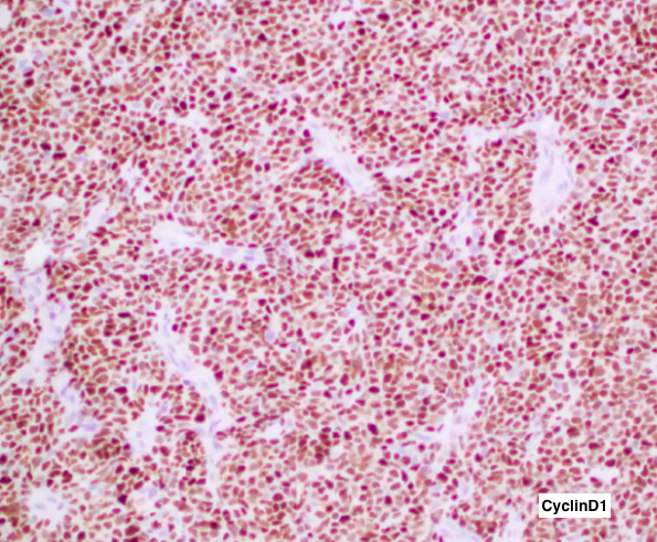 SibaElHussein's tweet photo. #LessonsFromtheFridayUnknowns Testicular CD5-NEGATIVE Mantle Cell Lymphoma with Blastoid &amp; Pleomorphic Features, a case that will certainly keep you on your feet: Unexpected location (testicle) &amp; CD5 negativity point toward other diagnoses first➡️https://t.co/wn1WELE4Yf #hemepath https://t.co/zrI03kiyvb