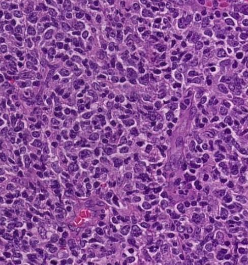 SibaElHussein's tweet photo. #LessonsFromtheFridayUnknowns Testicular CD5-NEGATIVE Mantle Cell Lymphoma with Blastoid &amp; Pleomorphic Features, a case that will certainly keep you on your feet: Unexpected location (testicle) &amp; CD5 negativity point toward other diagnoses first➡️https://t.co/wn1WELE4Yf #hemepath https://t.co/zrI03kiyvb