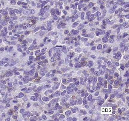 SibaElHussein's tweet photo. #LessonsFromtheFridayUnknowns Testicular CD5-NEGATIVE Mantle Cell Lymphoma with Blastoid &amp; Pleomorphic Features, a case that will certainly keep you on your feet: Unexpected location (testicle) &amp; CD5 negativity point toward other diagnoses first➡️https://t.co/wn1WELE4Yf #hemepath https://t.co/zrI03kiyvb