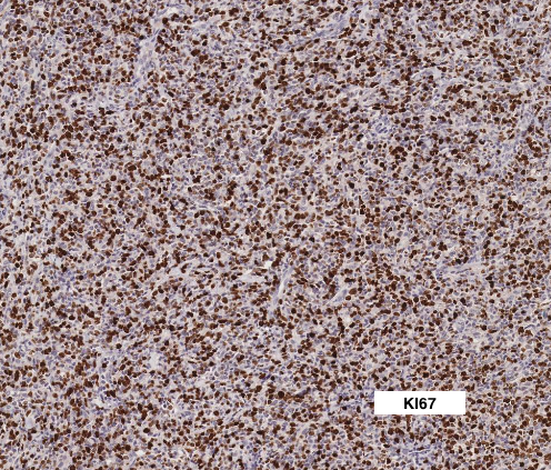 SibaElHussein's tweet photo. #LessonsFromtheFridayUnknowns Testicular CD5-NEGATIVE Mantle Cell Lymphoma with Blastoid &amp; Pleomorphic Features, a case that will certainly keep you on your feet: Unexpected location (testicle) &amp; CD5 negativity point toward other diagnoses first➡️https://t.co/wn1WELE4Yf #hemepath https://t.co/zrI03kiyvb