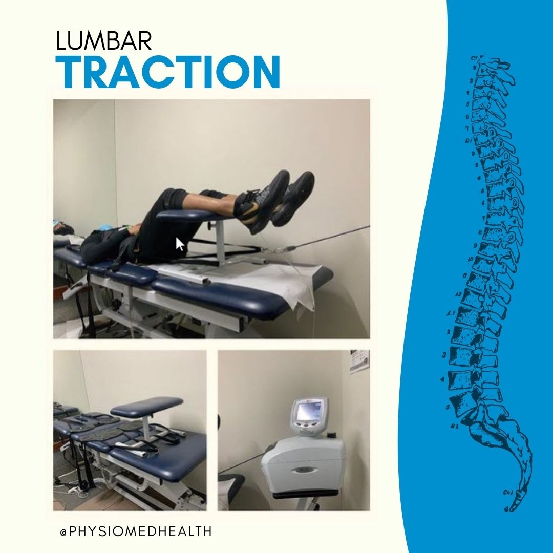 physiomedhealth's tweet image. The lumbar traction is a process of aplying a stretching force to the lumbar spine which helps to take pressure off of compressed discs at the lower back.

Book your consultation today: physiomed.ca

#lowerbackpainrelief #physiothmedhealth #lumbartraction
