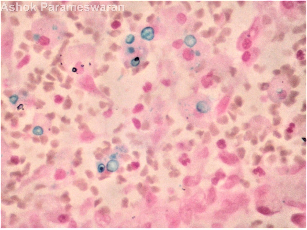 73/F Haematuria. Nodular lesion in Urinaru bladder on cystoscopy. Diagnosis? <a href="/slusagar/">Ankur Sangoi</a> <a href="/DrJuhlin/">C. Christofer Juhlin</a> <a href="/HENRYY_MD/">Henry YANG</a> @Cristin28431328 <a href="/vij_mukul/">Mukul Vij, MD 🇮🇳</a> <a href="/01sth02/">syed t. hoda</a> @girlscouter   <a href="/pepeheffernan/">Pepe Jiménez Heffernan</a> <a href="/LoboAnandi/">Anandi Lobo, MD</a> <a href="/kriyer68/">Kalyani Bambal</a> <a href="/Kashifhazim/">Kashif M M, MD, FRCPath</a> <a href="/atman_ci/">Dr. Luca</a> <a href="/Teclis82/">Brian McMillen MD</a>  <a href="/Meghna0630/">Meghna Madala</a> <a href="/VarshaManuchaMD/">Varsha Manucha, MD</a> <a href="/pepeheffernan/">Pepe Jiménez Heffernan</a>