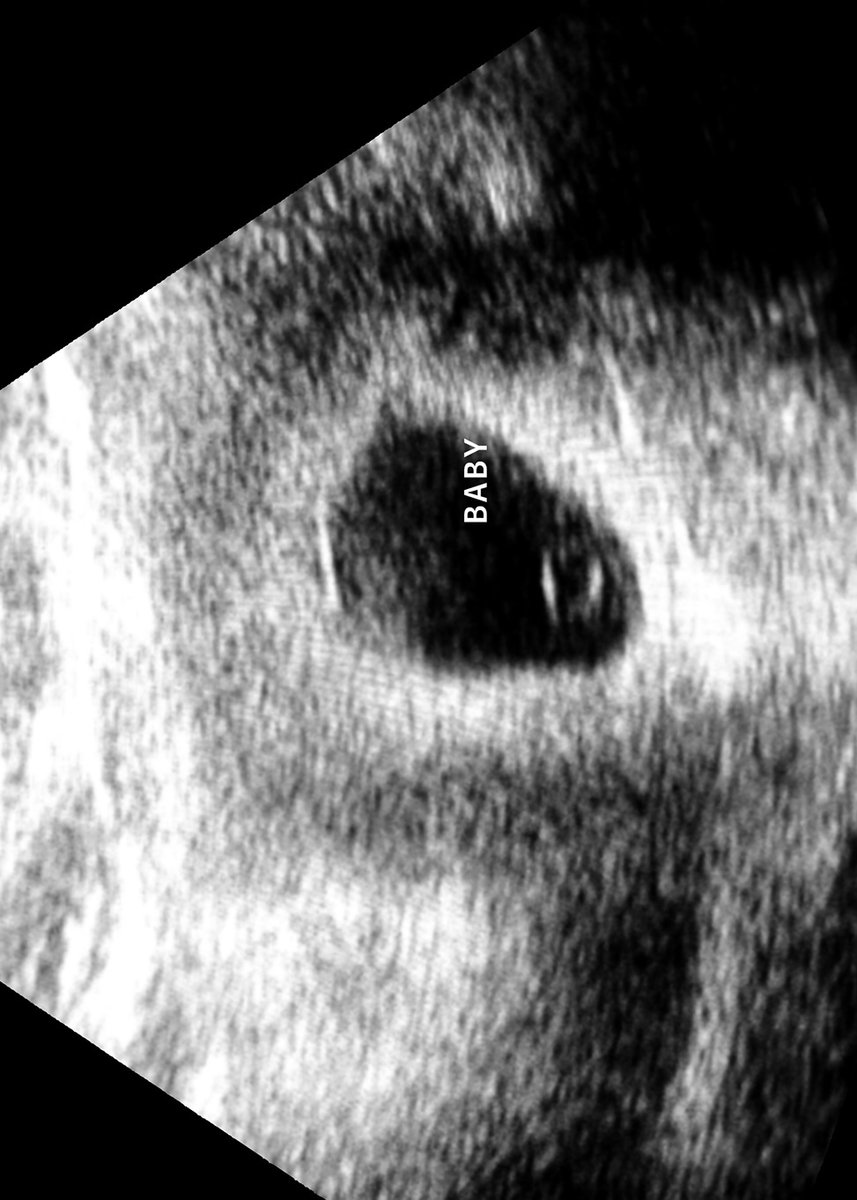 JunebugRva's tweet image. Baby number 6 and I’m scared as hell don’t know why I did this to myself