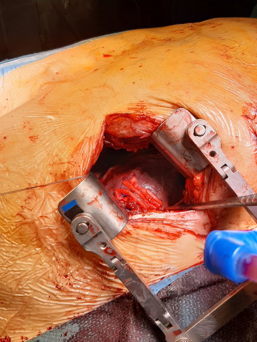 Cardiac Surgery Gregorio Marañon Hospital (@cardiacmaranon) on Twitter photo 《Midcab and TAVI with transapical approach. 2x1 surgery with minimal incision and fast recovery》
《Midcab y tavi transapical por toracotomia》
<a href="/gregoriocuerpo/">Gregorio</a>
<a href="/apedrazprieto/">Alvaro Pedraz</a>
<a href="/Atgpinto/">Angel Gonzalez Pinto</a>
<a href="/DiegoMonzonDiaz/">Diego Monzón Díaz</a>
<a href="/Laura5696/">Laura♥</a>
<a href="/YolandaVillaGa/">Yolanda Villa</a>
<a href="/carmenmereg/">Carmen García Meré</a>
#surgery #hgugm #madrid #heart
1/2 《Midcab and TAVI with transapical approach. 2x1 surgery with minimal incision and fast recovery》
《Midcab y tavi transapical por toracotomia》
<a href="/gregoriocuerpo/">Gregorio</a>
<a href="/apedrazprieto/">Alvaro Pedraz</a>
<a href="/Atgpinto/">Angel Gonzalez Pinto</a>
<a href="/DiegoMonzonDiaz/">Diego Monzón Díaz</a>
<a href="/Laura5696/">Laura♥</a>
<a href="/YolandaVillaGa/">Yolanda Villa</a>
<a href="/carmenmereg/">Carmen García Meré</a>
#surgery #hgugm #madrid #heart
1/2