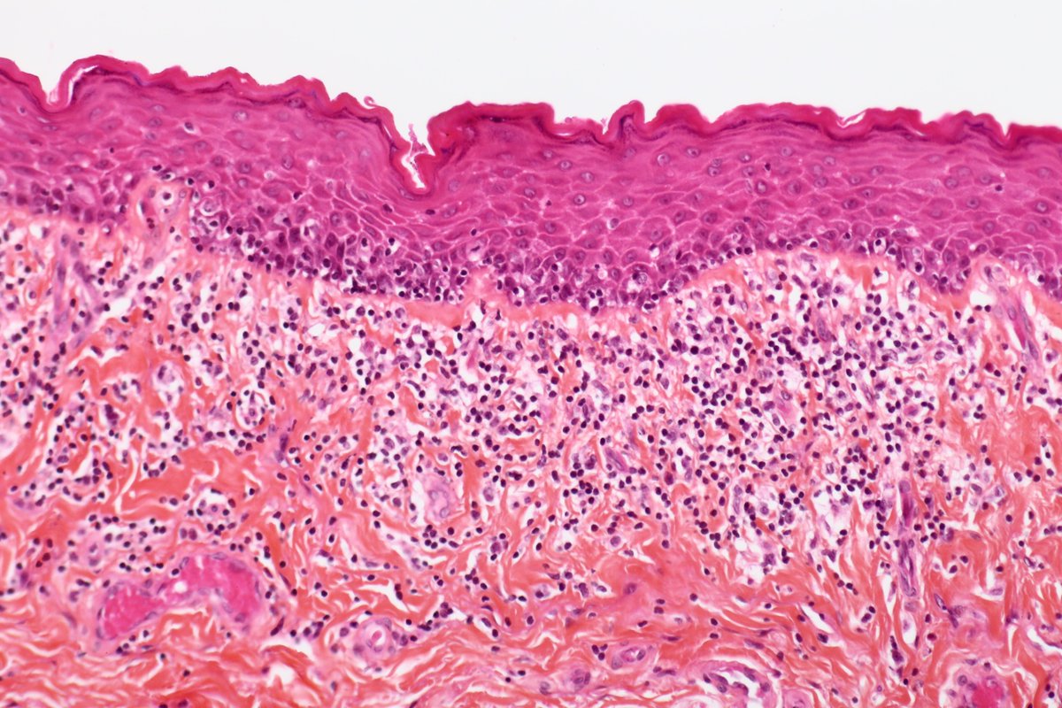 BattistellaMD's tweet photo. Classis example: What is this mycosis fungoides mimicker?
#PathTwitter #pathchallenge #mycosisfungoides #mimicker #dermpath #dermtwitter #hemepath https://t.co/tYMHiGOBAC