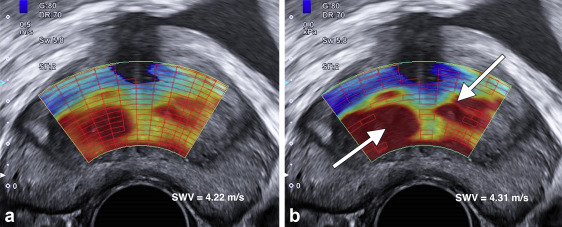 JVIRmedia's tweet photo. Role of Ultrasound Elastography in Patient Selection for Prostatic Artery Embolization. https://t.co/9dqCOciztJ #irad @AndrAssis16 https://t.co/cV26GKn62y