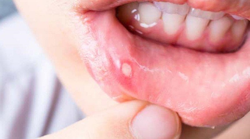 AlakocHealth's tweet photo. What Is Aphtha and How Does It Heal?

https://t.co/TfqMDk2nWN

#aphtha #mouth #health #aphthous #people #love #photography #fitness #ulcer #eyes #motivation #face #travel #lips #life #healthy #diases #portrait #instagood #workout #model #art #fit #cute #usa #gym #pose #newyork https://t.co/emfD5fFu5j