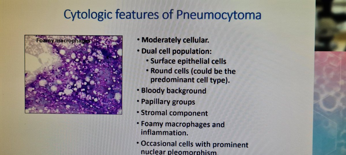 mdlozanoe's tweet photo. How many times did you make a cytological diagnosis of Pneumocytoma???👀👀🥺🥺. @mtsiddi gives us valuable guidelines for dealing with this entity 🙌👏👏#ECC2021Wroclaw https://t.co/oCzUaU8TXw